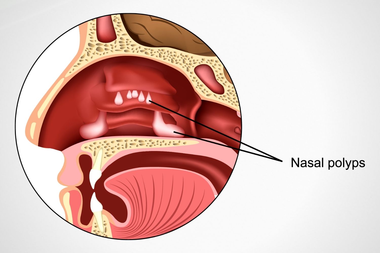 Nasal Polyps NuLife Hospital Gastroenterology, Liver Diseases