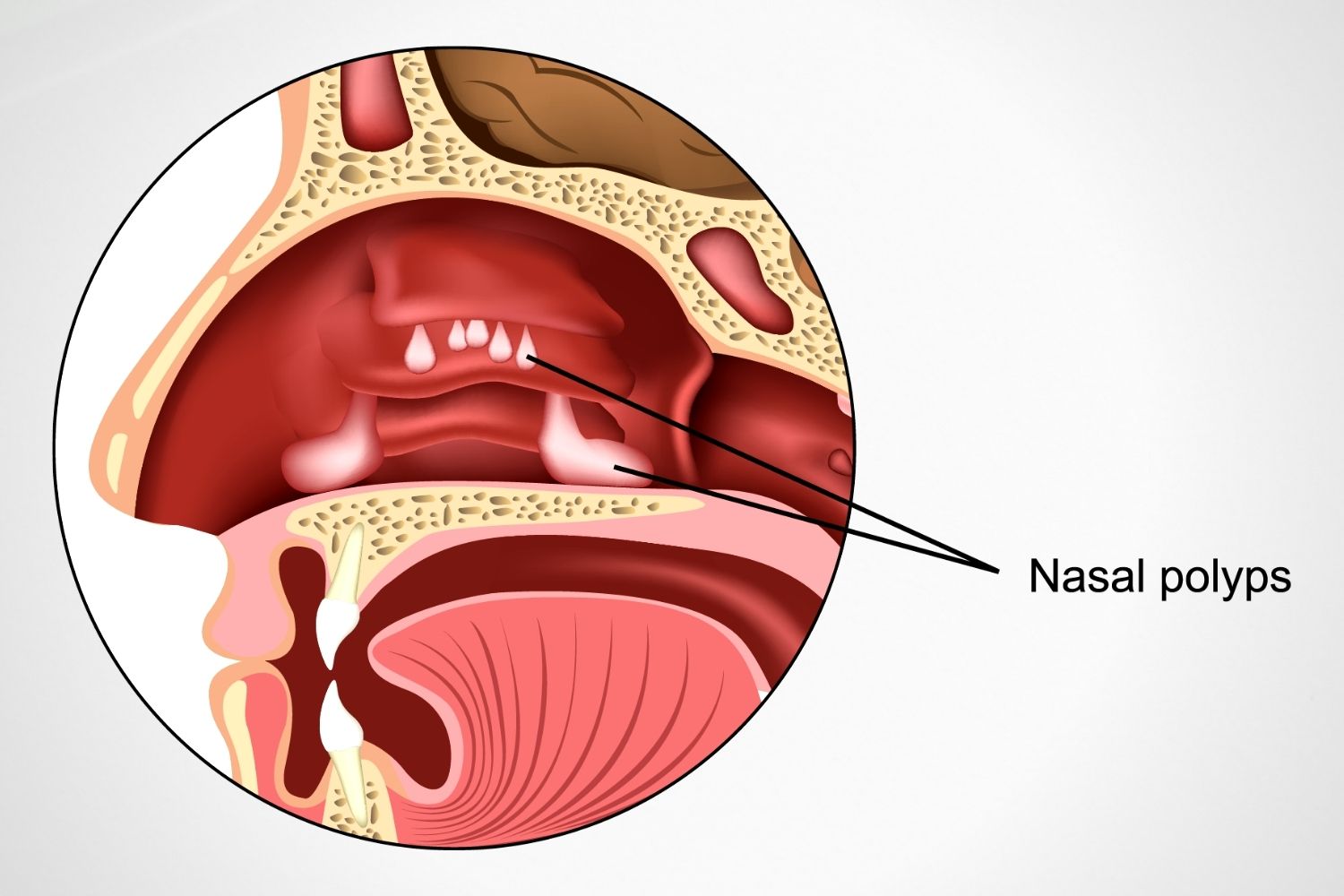 Nasal Polyps NuLife Hospital Gastroenterology Liver Diseases 